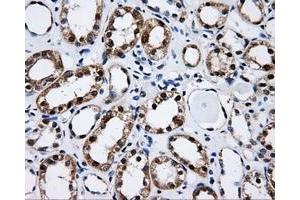 Immunohistochemical staining of paraffin-embedded Adenocarcinoma of ovary tissue using anti-CISD1mouse monoclonal antibody. (CISD1 抗体)