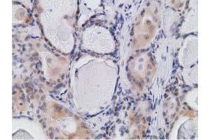 Immunohistochemical staining of paraffin-embedded Carcinoma of Human thyroid tissue using anti-RBBP9 mouse monoclonal antibody. (RBBP9 抗体)