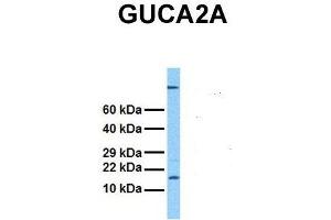 Host:  Rabbit  Target Name:  GUCA2A  Sample Tissue:  Human Stomach Tumor  Antibody Dilution:  1. (GUCA2A 抗体  (Middle Region))
