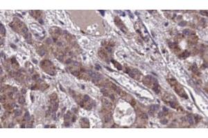ABIN6273873 at 1/100 staining Human liver cancer tissue by IHC-P. (GPR39 抗体  (C-Term))