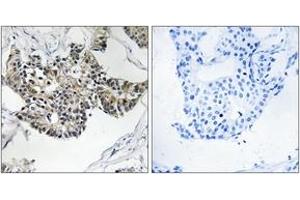 Immunohistochemistry analysis of paraffin-embedded human breast carcinoma tissue, using RSAD1 Antibody. (RSAD1 抗体  (AA 298-347))