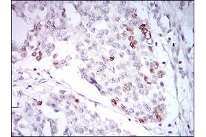 Immunohistochemical analysis of paraffin-embedded ovarian cancer tissues using TERF2 mouse mAb with DAB staining. (TRF2 抗体  (AA 324-500))