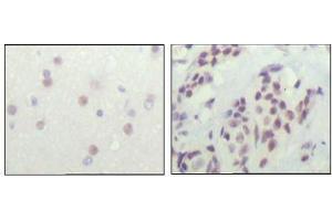 Immunohistochemical analysis of paraffin-embedded human cerebra (left) and breast carcinoma tissue (right), showing nuclear location with DAB staining using NCOR1 antibody.