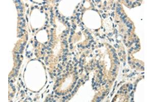 The image on the left is immunohistochemistry of paraffin-embedded Human thyroid cancer tissue using ABIN7193067(WNT6 Antibody) at dilution 1/35, on the right is treated with synthetic peptide. (WNT6 抗体)