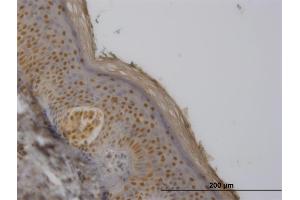 Immunoperoxidase of monoclonal antibody to FBXO11 on formalin-fixed paraffin-embedded human melanoma. (FBXO11 抗体  (AA 744-843))