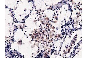 Immunohistochemical staining of paraffin-embedded Carcinoma of Human lung tissue using anti-OSBPL11 mouse monoclonal antibody. (OSBPL11 抗体)