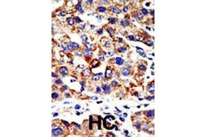 Formalin-fixed and paraffin-embedded human hepatocellular carcinoma tissue reacted with the HDAC8 polyclonal antibody  , which was peroxidase-conjugated to the secondary antibody, followed by AEC staining. (HDAC8 抗体  (N-Term))