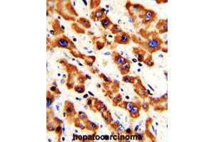 Formalin-fixed and paraffin-embedded human hepatocarcinomareacted with PHB polyclonal antibody , which was peroxidase-conjugated to the secondary antibody, followed by AEC staining. (Prohibitin 抗体  (AA 99-129))