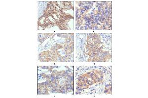 Immunohistochemical analysis of paraffin-embedded human breast intraductal carcinama tissues (A) and breast infiltrating ductal carcinama tissues (B) showing membrane localization using ERBB2 mouse mAb with DAB staining. (ErbB2/Her2 抗体  (AA 750-987))
