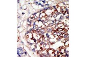 Formalin-fixed and paraffin-embedded human cancer tissue reacted with the primary antibody, which was peroxidase-conjugated to the secondary antibody, followed by DAB staining. (DYRK1B 抗体  (C-Term))