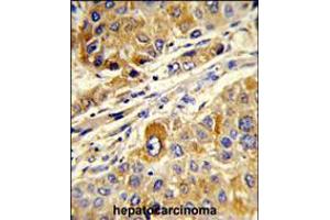 Formalin-fixed and paraffin-embedded human hepatocarcinoma reacted with MASTL Antibody, which was peroxidase-conjugated to the secondary antibody, followed by DAB staining. (MASTL 抗体)