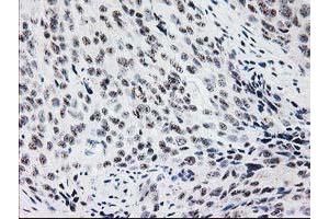 Immunohistochemical staining of paraffin-embedded Adenocarcinoma of Human breast tissue using anti-MGLL mouse monoclonal antibody. (MGLL 抗体)