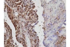 IHC-P Image Immunohistochemical analysis of paraffin-embedded human serous ovarian cancer, using VAV1, antibody at 1:100 dilution. (VAV1 抗体  (Center))