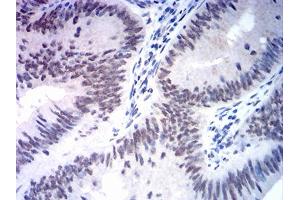 Immunohistochemical analysis of paraffin-embedded rectum cancer tissues using MSH2 mouse mAb with DAB staining. (MSH2 抗体  (AA 442-586))