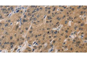 Immunohistochemistry of paraffin-embedded Human liver cancer tissue using DUSP26 Polyclonal Antibody at dilution 1:60 (DUSP26 抗体)