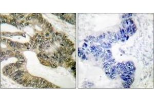 Immunohistochemistry analysis of paraffin-embedded human colon carcinoma tissue, using APC Antibody. (APC 抗体  (AA 2794-2843))