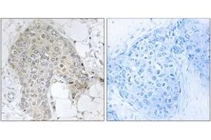 Immunohistochemistry analysis of paraffin-embedded human breast carcinoma tissue, using PPP1R2 (Ab-120/121) Antibody. (PPP1R2 抗体  (AA 86-135))