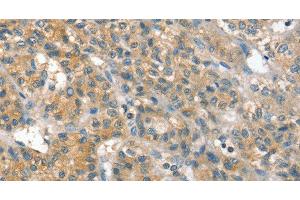 Immunohistochemistry of paraffin-embedded Human liver cancer using PPP2CA Polyclonal Antibody at dilution of 1:35 (PPP2CA 抗体)