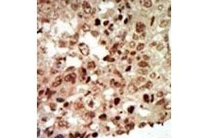 Formalin-fixed and paraffin-embedded human cancer tissue reacted with the primary antibody, which was peroxidase-conjugated to the secondary antibody, followed by AEC staining. (MAPK11 抗体  (AA 334-366))