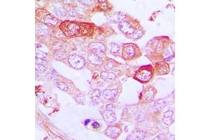 Immunohistochemical analysis of A20 staining in human lung cancer formalin fixed paraffin embedded tissue section. (IGKV1-27 抗体  (Center))
