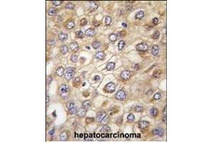 Formalin-fixed and paraffin-embedded human hepatocarcinoma tissue reacted with CLDN2 (Human N-term) (ABIN390291 and ABIN2840730) , which was peroxidase-conjugated to the secondary antibody, followed by DAB staining. (Claudin 2 抗体  (N-Term))