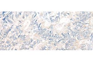 Immunohistochemistry of paraffin-embedded Human gastric cancer tissue using PNPO Polyclonal Antibody at dilution of 1:30(x200) (PNPO 抗体)