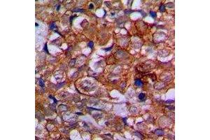 Immunohistochemical analysis of EPHA1 staining in human prostate cancer formalin fixed paraffin embedded tissue section.