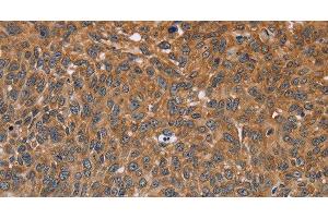 Immunohistochemistry of paraffin-embedded Human lung cancer using GH2 Polyclonal Antibody at dilution of 1:40 (Growth Hormone 2 抗体)