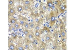 Immunohistochemistry of paraffin-embedded Human liver damage using TLK2 Polyclonal Antibody at dilution of 1:100 (40x lens). (TLK2 抗体)