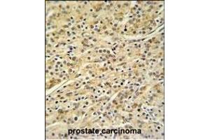 HOXA3 Antibody (C-term) (ABIN653846 and ABIN2843109) IHC analysis in formalin fixed and paraffin embedded prostate carcinoma followed by peroxidase conjugation of the secondary antibody and DAB staining. (HOXA3 抗体  (C-Term))
