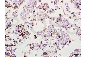 Formalin-fixed and paraffin embedded rat lung melanoma labeled with Anti-MAGE-1 Polyclonal Antibody, Unconjugated (ABIN728578) at 1:200, followed by conjugation to the secondary antibody and DAB staining (MAGEA1 抗体  (AA 101-200))