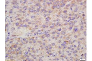 Formalin-fixed and paraffin embedded human liver carcinoma labeled with Rabbit Anti-Hepsin Polyclonal Antibody, Unconjugated (ABIN716816) at 1:200 followed by conjugation to the secondary antibody and DAB staining (Hepsin 抗体  (AA 311-417))