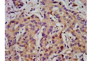 IHC image of ABIN7175596 diluted at 1:500 and staining in paraffin-embedded human liver cancer performed on a Leica BondTM system. (CACNB2 抗体  (AA 490-637))