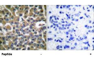 Immunohistochemical analysis of paraffin-embedded human breast carcinoma tissue using EEF2 polyclonal antibody . (EEF2 抗体  (Thr56))