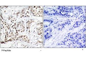 Immunohistochemical analysis of paraffin-embedded human breast carcinoma tissue using MAPK9/MAPK10 (phospho T183) polyclonal antibody . (JNK2 抗体  (pThr183))