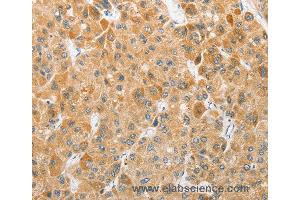 Immunohistochemistry of Human liver cancer using ATG5 Polyclonal Antibody at dilution of 1:40 (ATG5 抗体)