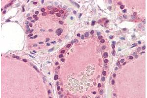 Human Thyroid (formalin-fixed, paraffin-embedded) stained with EPHA2 antibody ABIN364396 at 5 ug/ml followed by biotinylated anti-mouse IgG secondary antibody ABIN481714, alkaline phosphatase-streptavidin and chromogen.