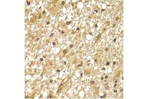 Immunohistochemistry of paraffin-embedded human brain cancer using PIK3R3 antibody at dilution of 1:100 (x400 lens). (PIK3R3 抗体)