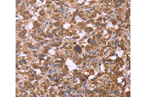 Immunohistochemistry of Human liver cancer using FBXW7 Polyclonal Antibody at dilution of 1:30 (FBXW7 抗体)