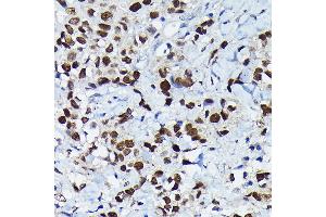 Immunohistochemistry of paraffin-embedded human breast cancer using C/EBPB Rabbit pAb (ABIN6134025, ABIN6138382, ABIN6138383 and ABIN6213964) at dilution of 1:100 (40x lens). (CEBPB 抗体  (AA 150-250))
