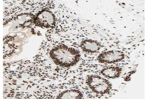 ABIN6266629 at 1/100 staining human colon carcinoma tissue sections by IHC-P. (RCBTB1 抗体  (Internal Region))