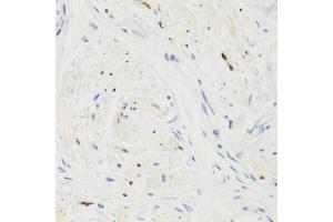 Immunohistochemistry of paraffin-embedded human breast cancer using GEMIN2 Antibody (ABIN1872798) at dilution of 1:100 (40x lens). (SIP1 抗体)
