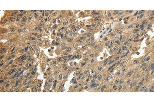 Immunohistochemistry of paraffin-embedded Human ovarian cancer using GSR Polyclonal Antibody at dilution of 1:50 (Glutathione Reductase 抗体)