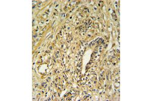 HSD17B2 Antibody IHC analysis in formalin fixed and paraffin embedded human prostate carcinoma followed by peroxidase conjugation of the secondary antibody and DAB staining. (HSD17B2 抗体  (AA 265-294))
