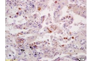 Formalin-fixed and paraffin embedded human lung carcinoma labeled with Anti-SDHB Polyclonal Antibody, Unconjugated (ABIN719411) at 1:200 followed by conjugation to the secondary antibody and DAB staining. (SDHB 抗体  (AA 201-280))