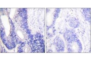 Immunohistochemistry analysis of paraffin-embedded human colon carcinoma tissue, using Claudin 3 Antibody. (Claudin 3 抗体  (AA 171-220))