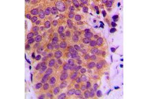 Immunohistochemical analysis of MKK4 (pS80) staining in human breast cancer formalin fixed paraffin embedded tissue section. (MAP2K4 抗体  (pSer80))