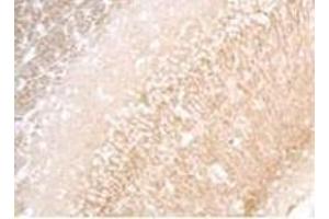 Formalin-Fixed, Paraffin-Embedded human cancer tissue reacted with the primary antibody Cleaved-LC3 Antibody (APG8a) followed which was peroxidase-conjugated to the secondary antibody, followed by DAB staining.