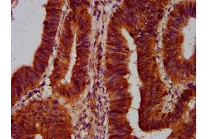 IHC image of ABIN7170028 diluted at 1:500 and staining in paraffin-embedded human colon cancer performed on a Leica BondTM system.
