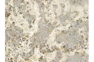 ABIN6261234 and ABIN6272285 at 1/100 staining human melanoma by IHC-P. (DCL1 抗体  (Internal Region))